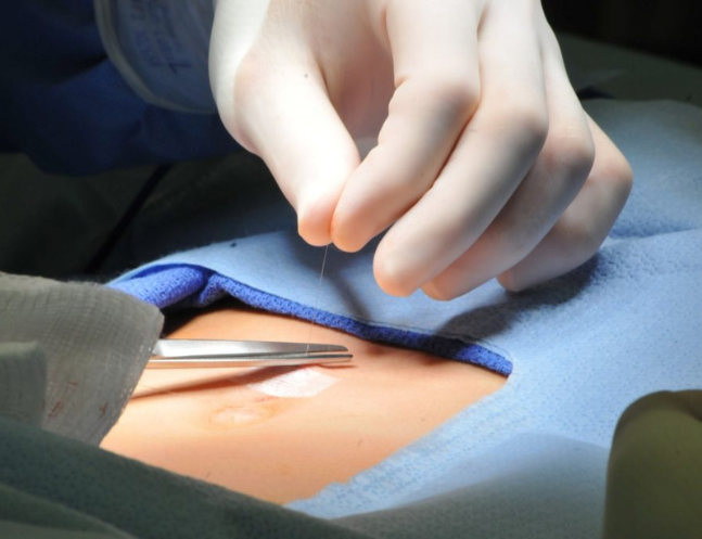 Hernia Repair