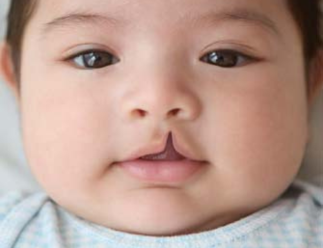 Cleft Lip and Palate Repair