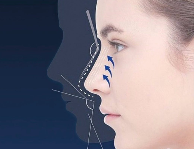 Rhinoplasty