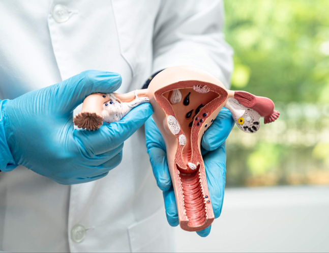 Uterine Fibroids