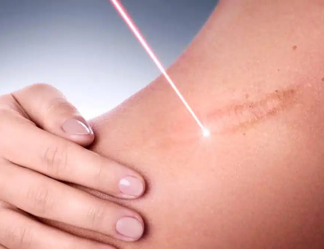 Scar Revision & Keloid Removal