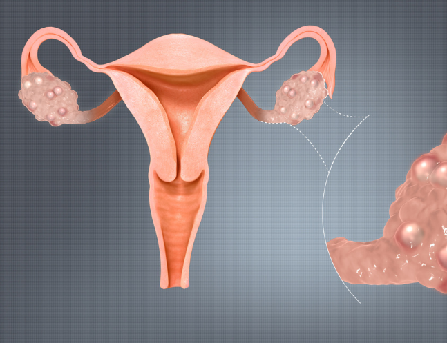 PCOS