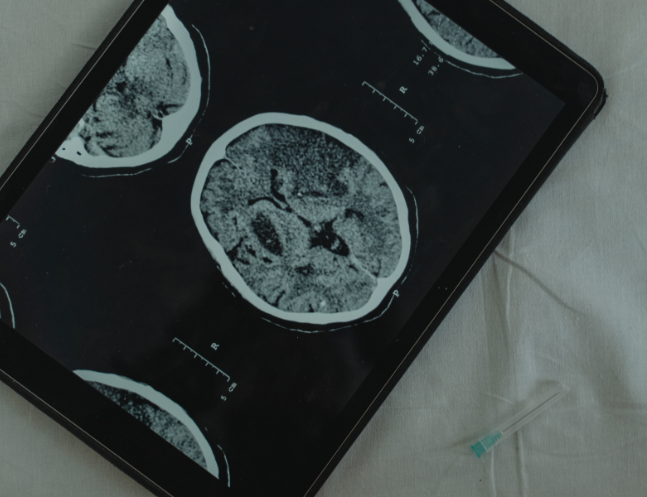 Brain Tumors