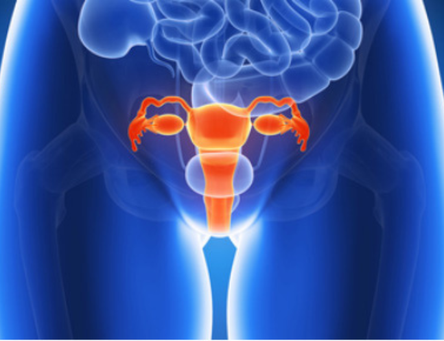 Ovarian Cysts